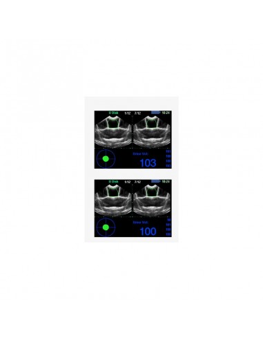 Analizador vejigal de ultrasonido BVT02